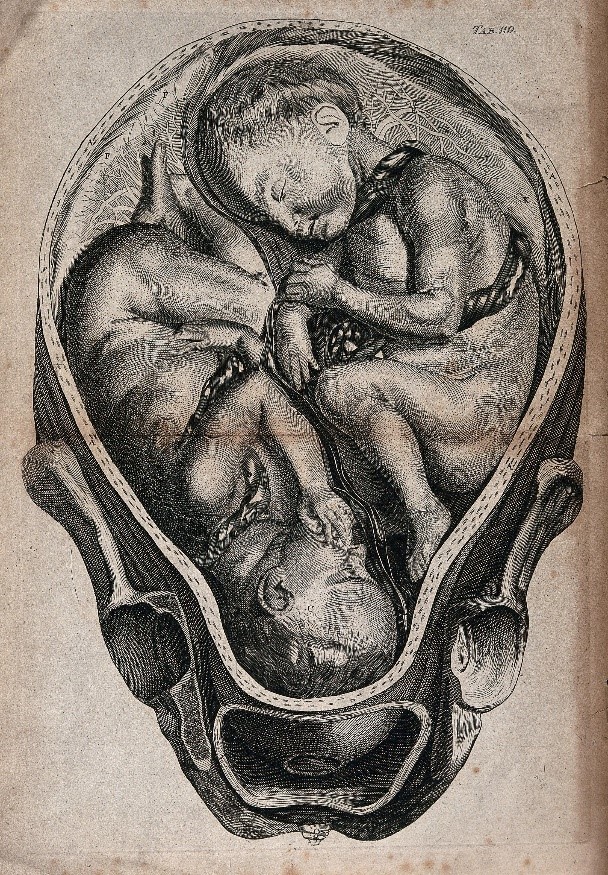 A cross-section of a pregnant uterus containing twins